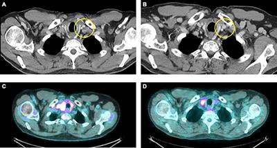 Case Report: Significant Clinical Benefit From Pemetrexed-Based Therapy in ROS1- and ALK-rearranged Lung Cancer With Adenosquamous Histology